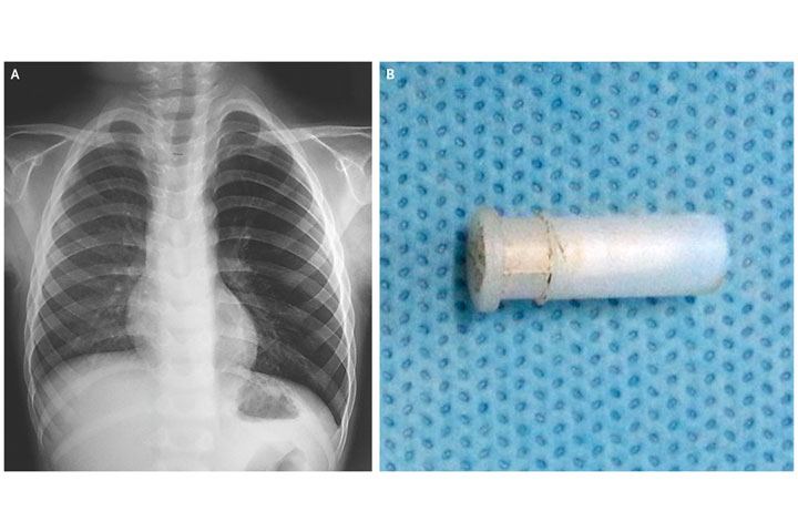 Radioscopy of a four-year-old boy showing hyperinflation of his left lung (left). On the right, the cause of his cough.