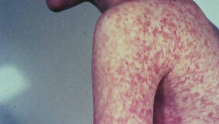 Person with measles visited Edmonton airport, Stollery Children’s Hospital: AHS