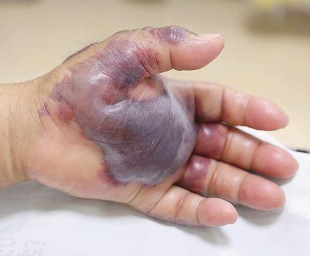 A photo of a Korean man’s hand after he was infected with Vibrio vulnificus.