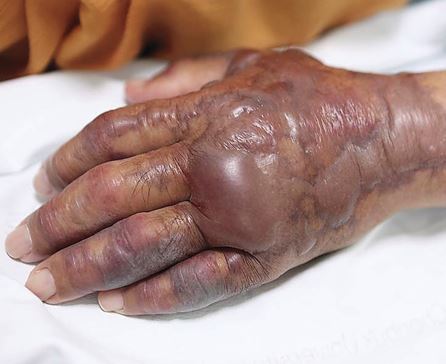 A photo of a Korean man’s hand after he was infected with Vibrio vulnificus.