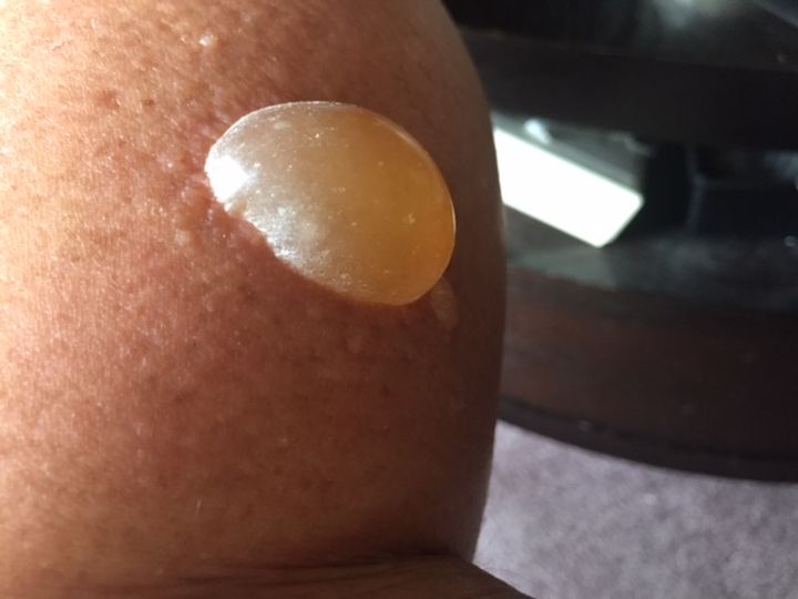 Calgary woman Jackie Gilluley hopes her experience will help more people to take wasp stings seriously.