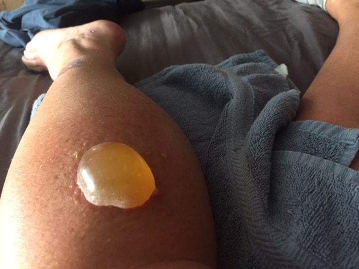 Jackie Gilluley said about two days after she was stung by a wasp, she had developed an egg-sized blister.