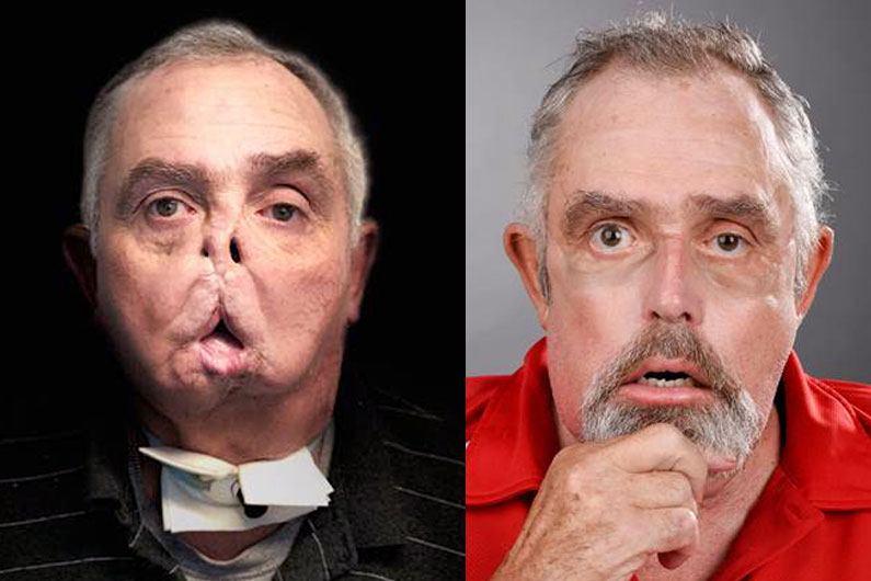 First Canadian face transplant: Man doing well after life-changing surgery - image