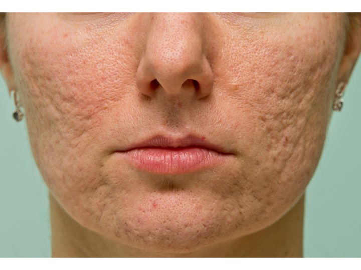 How Do Acne Scars Form News Videos Articles