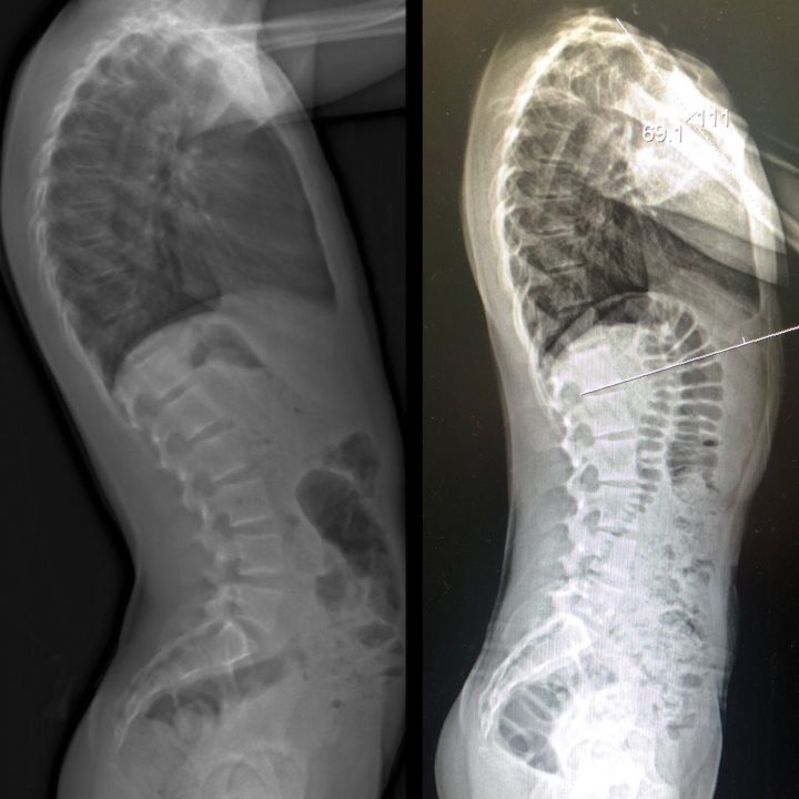 Saskatchewan family pushes for the province to modernize its back braces - image