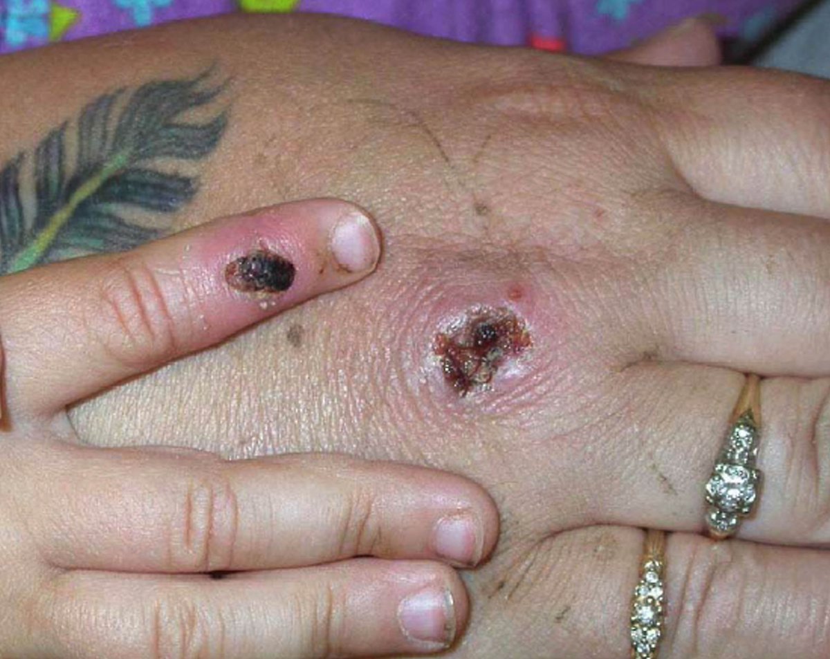 In this undated Centers for Disease Control and Prevention handout graphic, symptoms of one of the first known cases of the monkeypox virus in the U.S. are shown on a patient's hand. 
