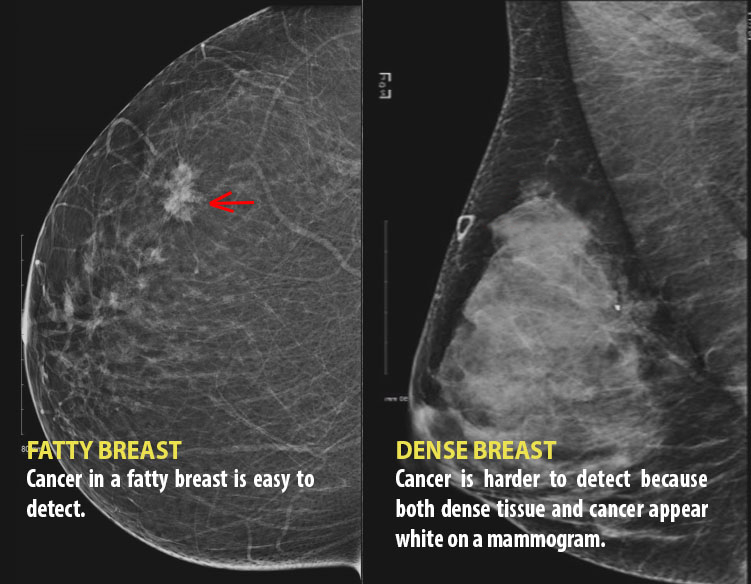 We Need To Talk About Dense Breasts: Why Governments Are Taking Notice ...