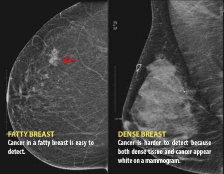 We need to talk about dense breasts: Why governments are taking notice ...