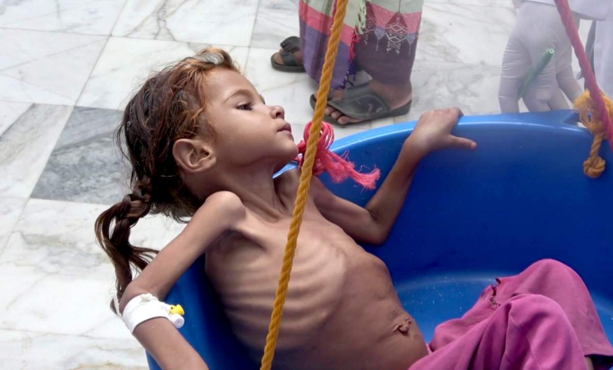 In this Aug. 25, 2018 file image made from video, a severely malnourished girl is weighed at the Aslam Health Center in Hajjah, Yemen.