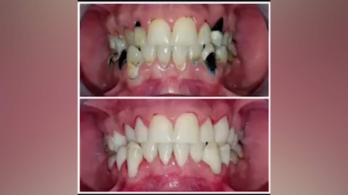 Before and after images show the changes to David Cowart’s teeth following a procedure.