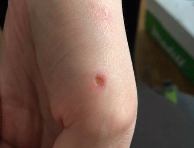 Amelia’s hand after she was bitten by Honey.