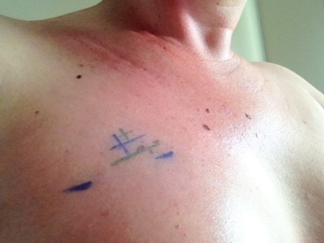 Laura McNeill had a double mastectomy and implants.