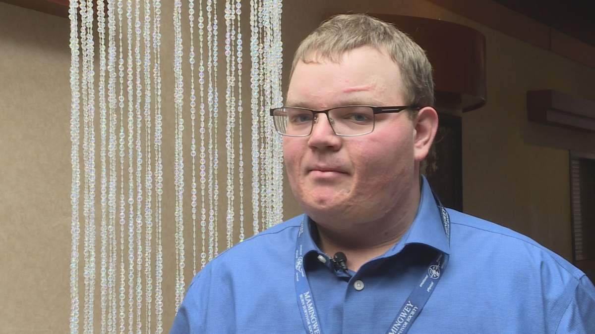 Dawson Blahey suffered third-degree burns on his body when he was just four years old.