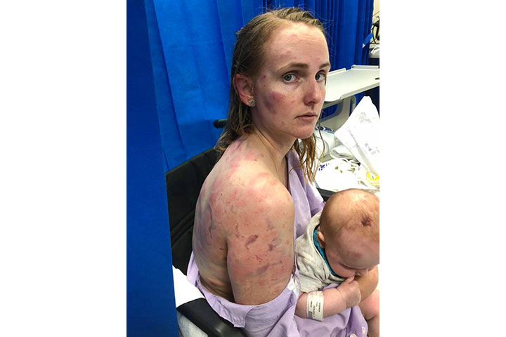 Queensland was hit with a super-cell storm that rained down tennis-ball-sized hail, leaving thousands without power. Fiona Simpson was caught in the middle of it.