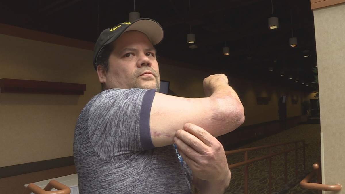 Blair Lundie was burned in a high-voltage explosion.