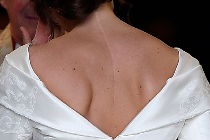 Princess eugenie 2025 wedding scar