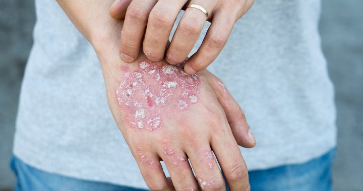 psoriasis home remedies reddit nagy piros foltok a kezeken mi ez