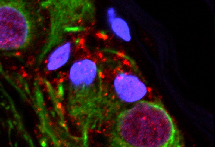This microscope image provided by the Van Andel Research Institute in October 2018 shows an abnormal protein that is a hallmark of Parkinson's disease clumped inside the appendix. 