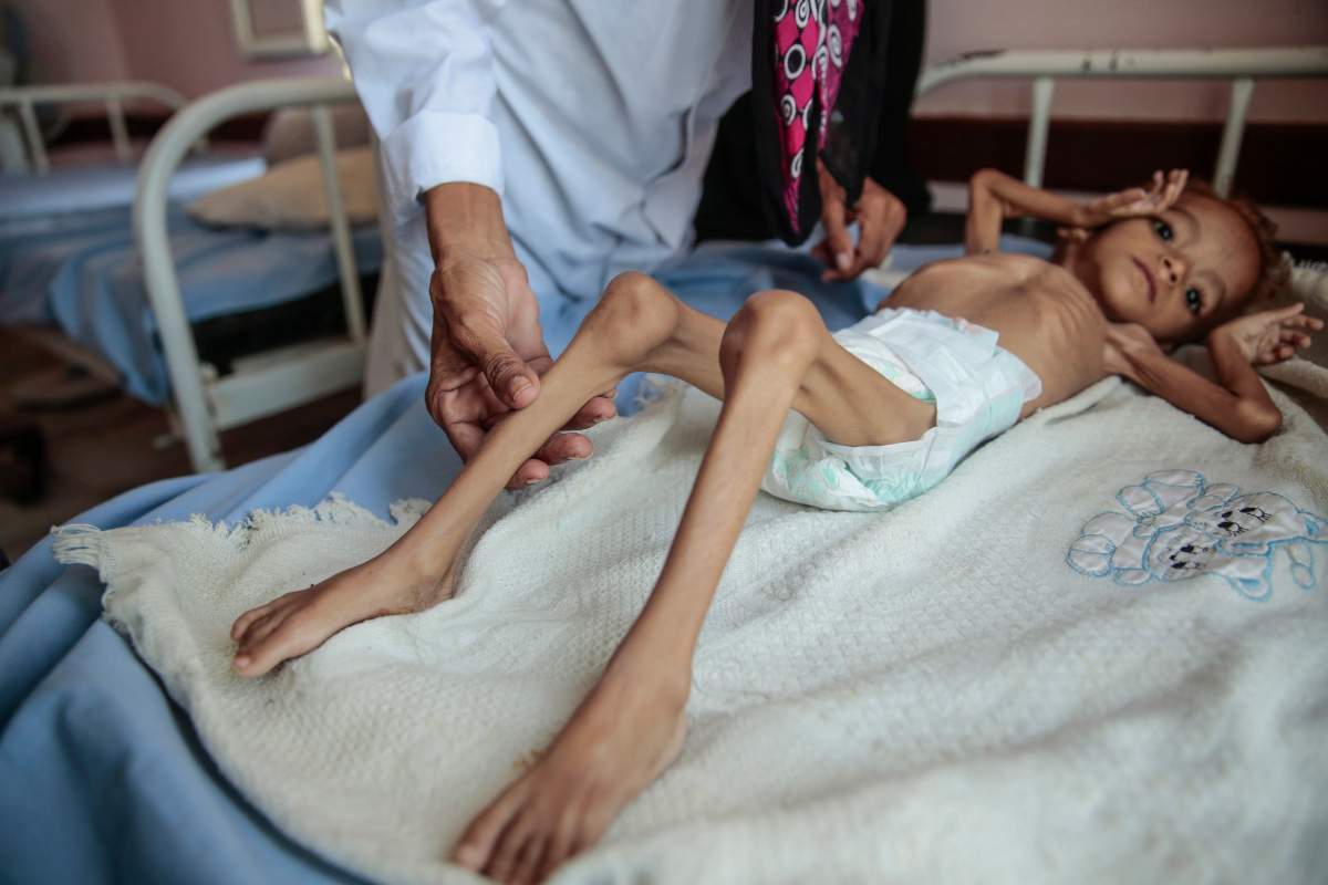 In this Oct. 1, 2018, photo, a severely malnourished boy rests on a hospital bed at the Aslam Health Center, Hajjah, Yemen. 