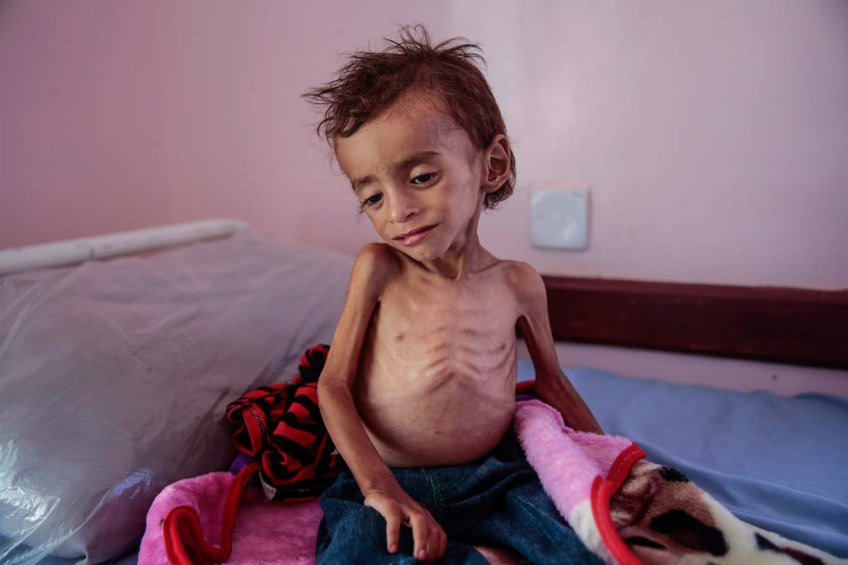 In this Oct. 1, 2018, photo, a malnourished boy sits on a hospital bed at the Aslam Health Center, Hajjah, Yemen. 
