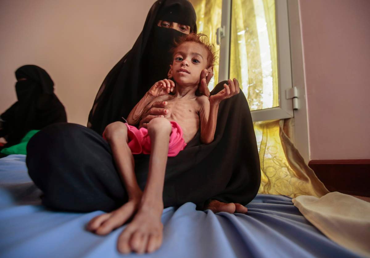 In this Oct. 1, 2018, photo, a woman holds a malnourished boy at the Aslam Health Center, in Hajjah, Yemen.