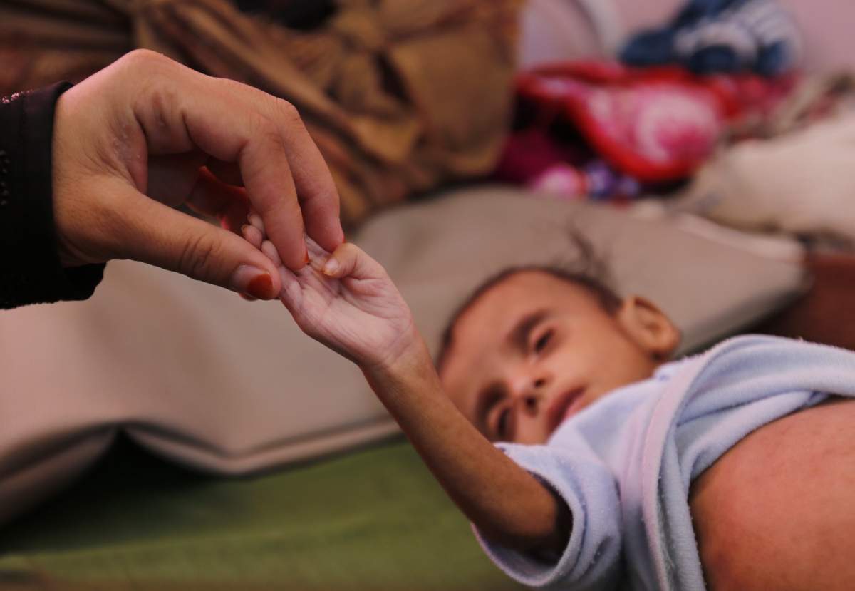A Yemeni woman holds a hand of her malnourished child as he receives medical attention at a malnutrition treatment center in Sana'a, Yemen, 16 November 2018. 
