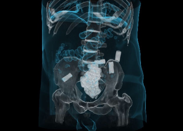 Drugs inside someone’s body.