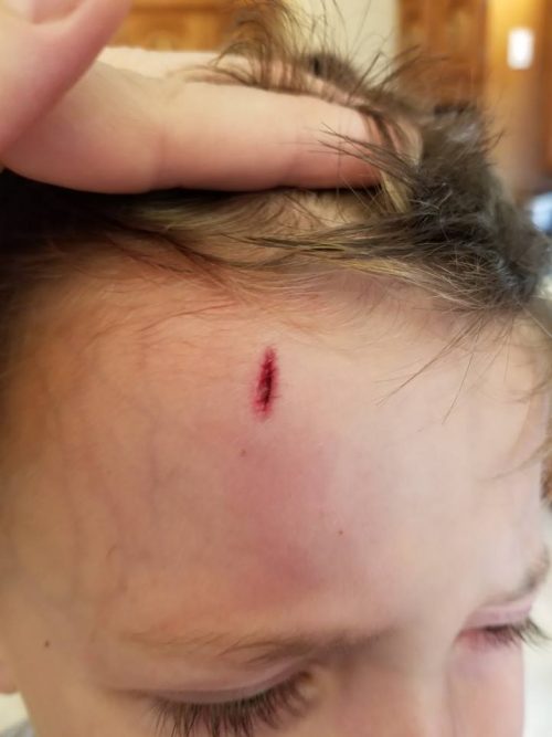 When Should Parents Be Worried About Head Bumps And Bruises In Kids Globalnews Ca