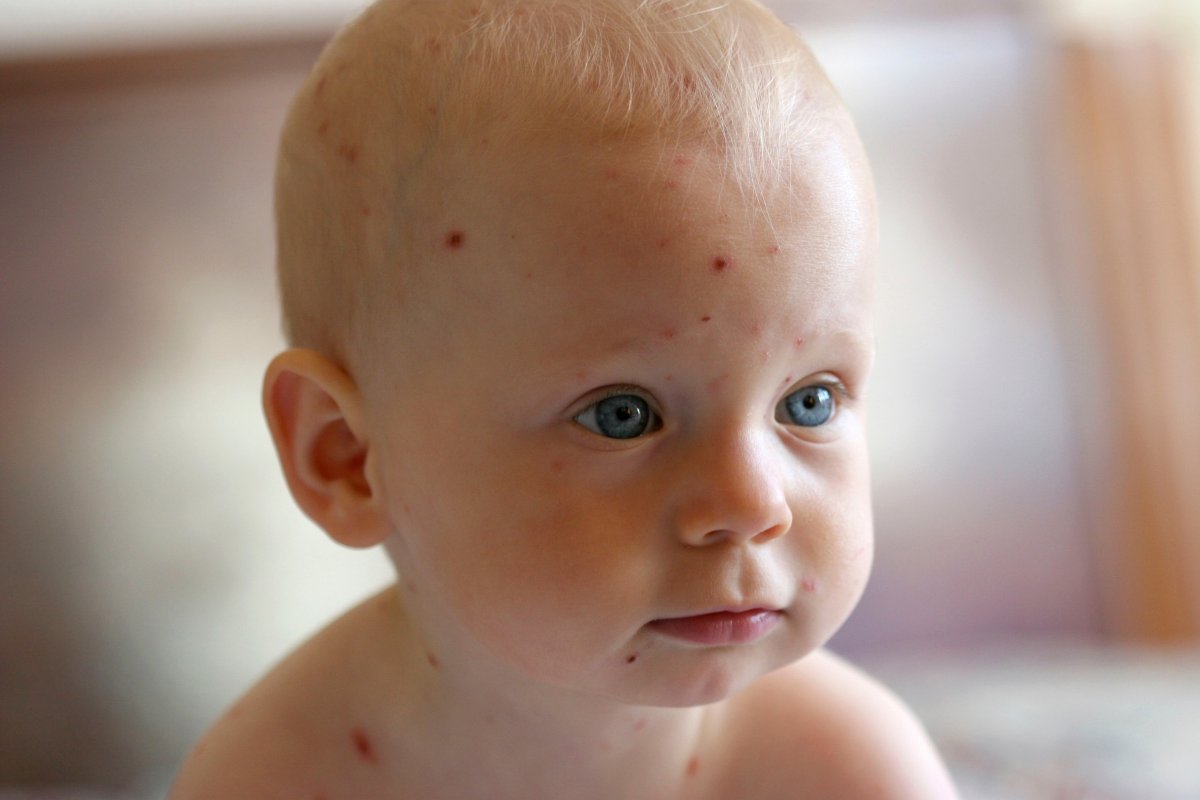 FILE -- A one-year-old with chickenpox on fifth day of infection.
