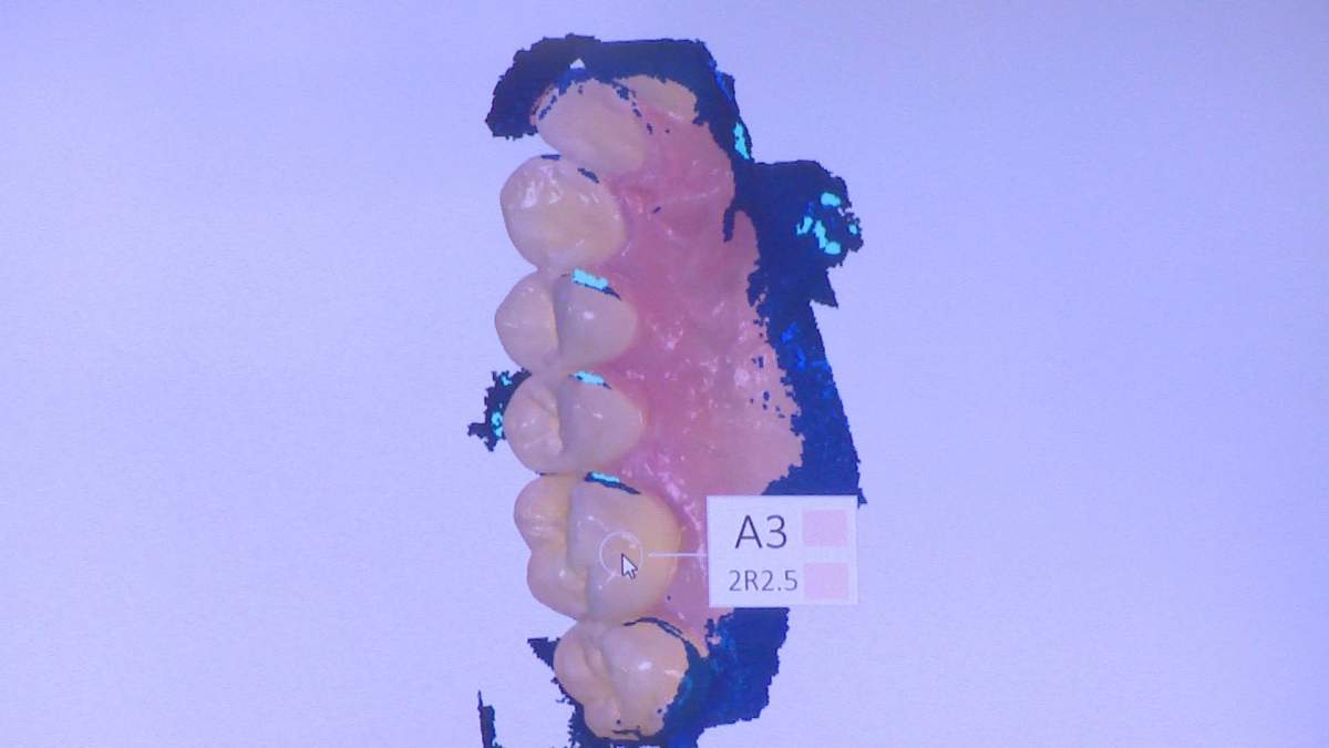 The intraoral scanner creates a 3D image of a patient\’s teeth.