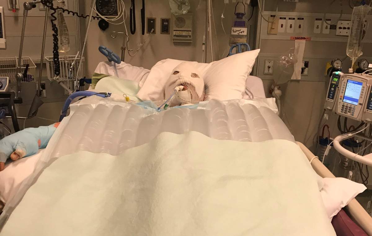 Penticton resident Johnny Rowlands is recovering in hospital after a mobile home fire caused second degree burns on Friday. 
