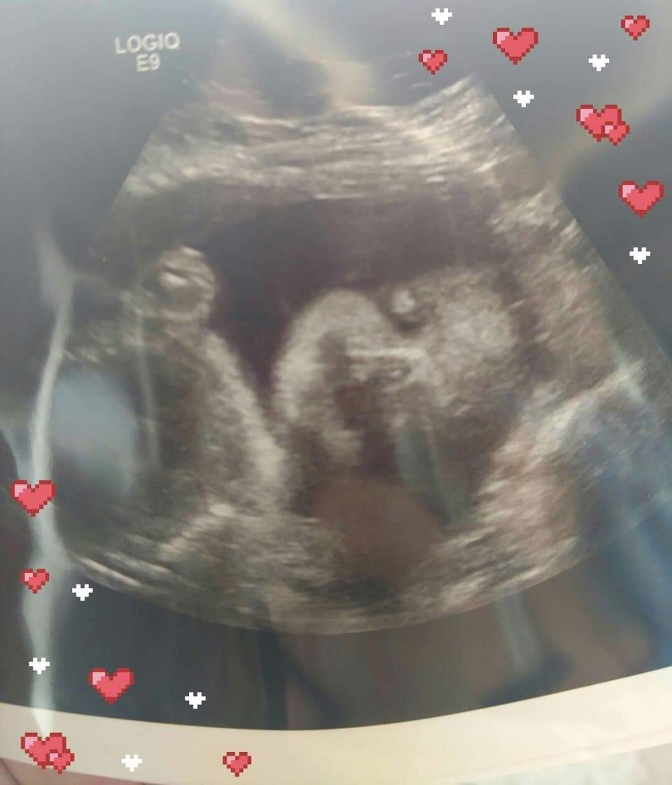 U.S. couple’s adoption dreams crushed after birth mom fakes pregnancy - image