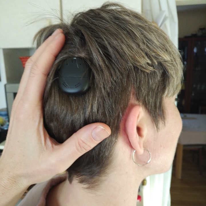 Caroline Schwabe and her cochlear implant.