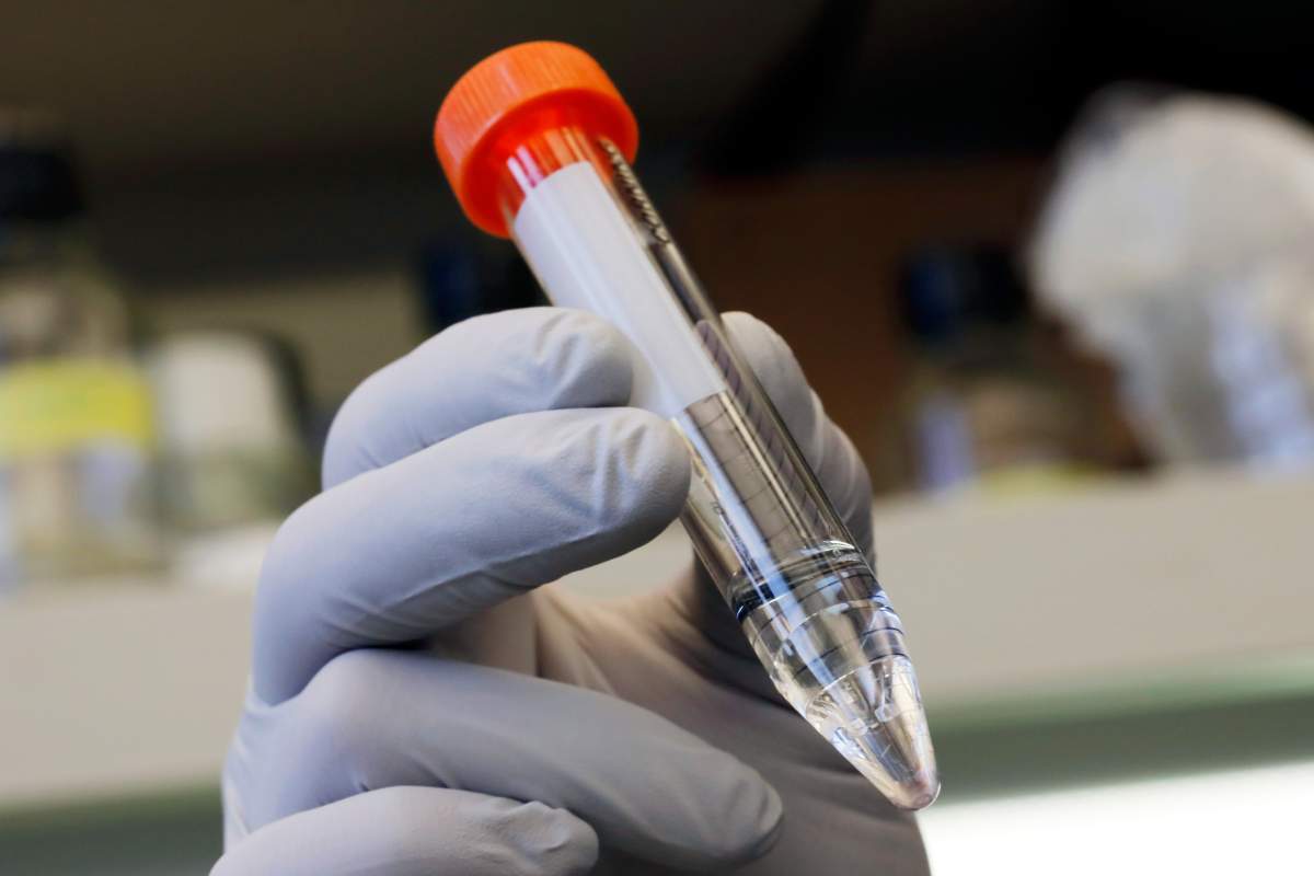 Yale University researcher Benjamin Chan, who studies viruses that attack bacteria, holds bacteriophage treatment for patient Ella Balasa, of Richmond, Va., at Osborn Memorial Laboratories, in New Haven, Conn., Thursday Jan. 17, 2019. Bacteriophages were discovered a century ago but largely shelved when easier-to-use antibiotics came along.