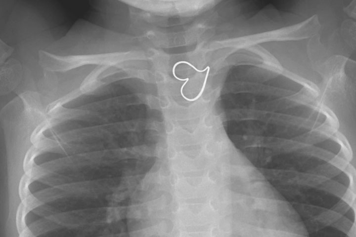 An X-ray image of a three-year-old girl, with a gold heart pendant stuck in her esophagus.