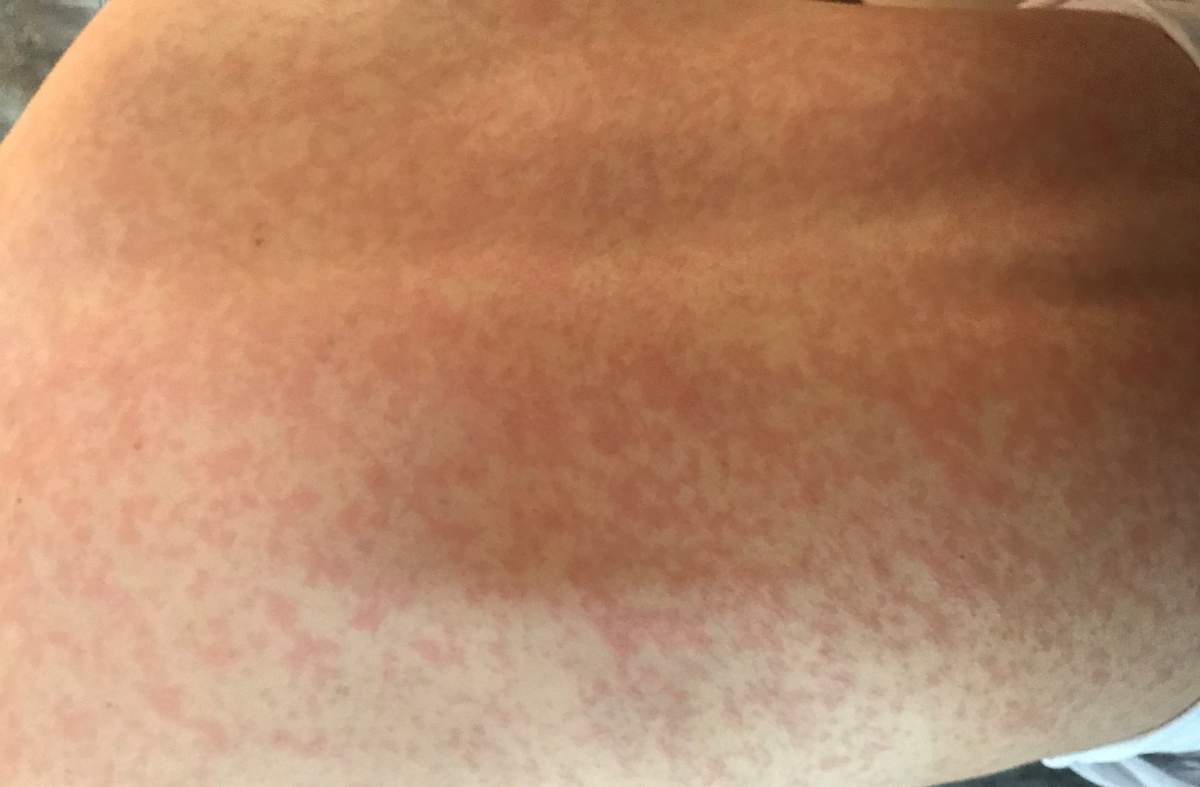 A picture of the rash shown to doctors at Delta Hospital, who reportedly didn’t consider measles a possibility. The patient was put into isolation at St. Paul’s in Vancouver immediately after doctors saw the rash.