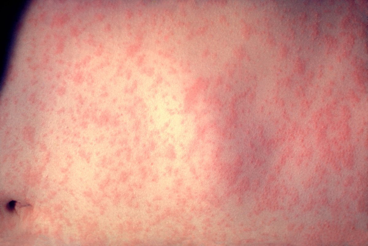 A patient with the classic measles rash is seen in this handout photo from the CDC. 