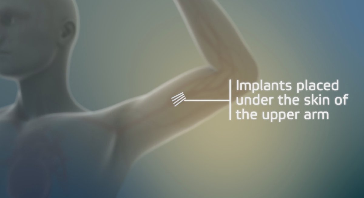 The matchstick sized implants are inserted into a patient's arm, and release the drug buprenorphine for up to six months. 