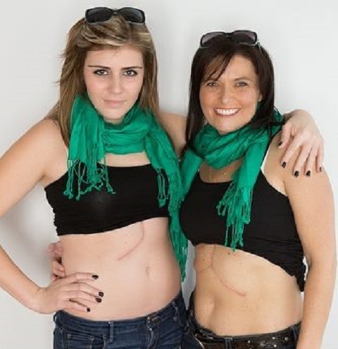Erica Horgan, left, donated part of her liver to her neighbour, Renee Ly.