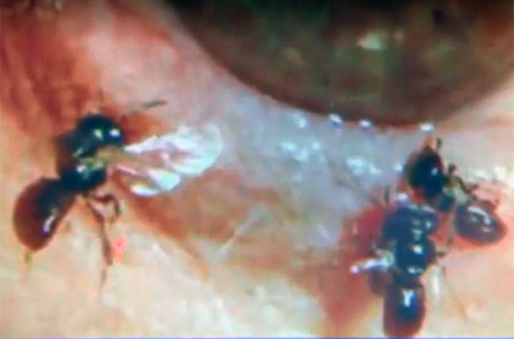 A Taiwanese woman had living bees removed from one of her eyes, a doctors at Fooyin University Hospital revealed last Wednesday.