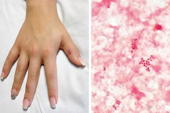 Una donna con pustole legate alla gonorrea sulla mano, e un primo piano di un'emocoltura che cresce il batterio Neisseria gonorrhoeae.