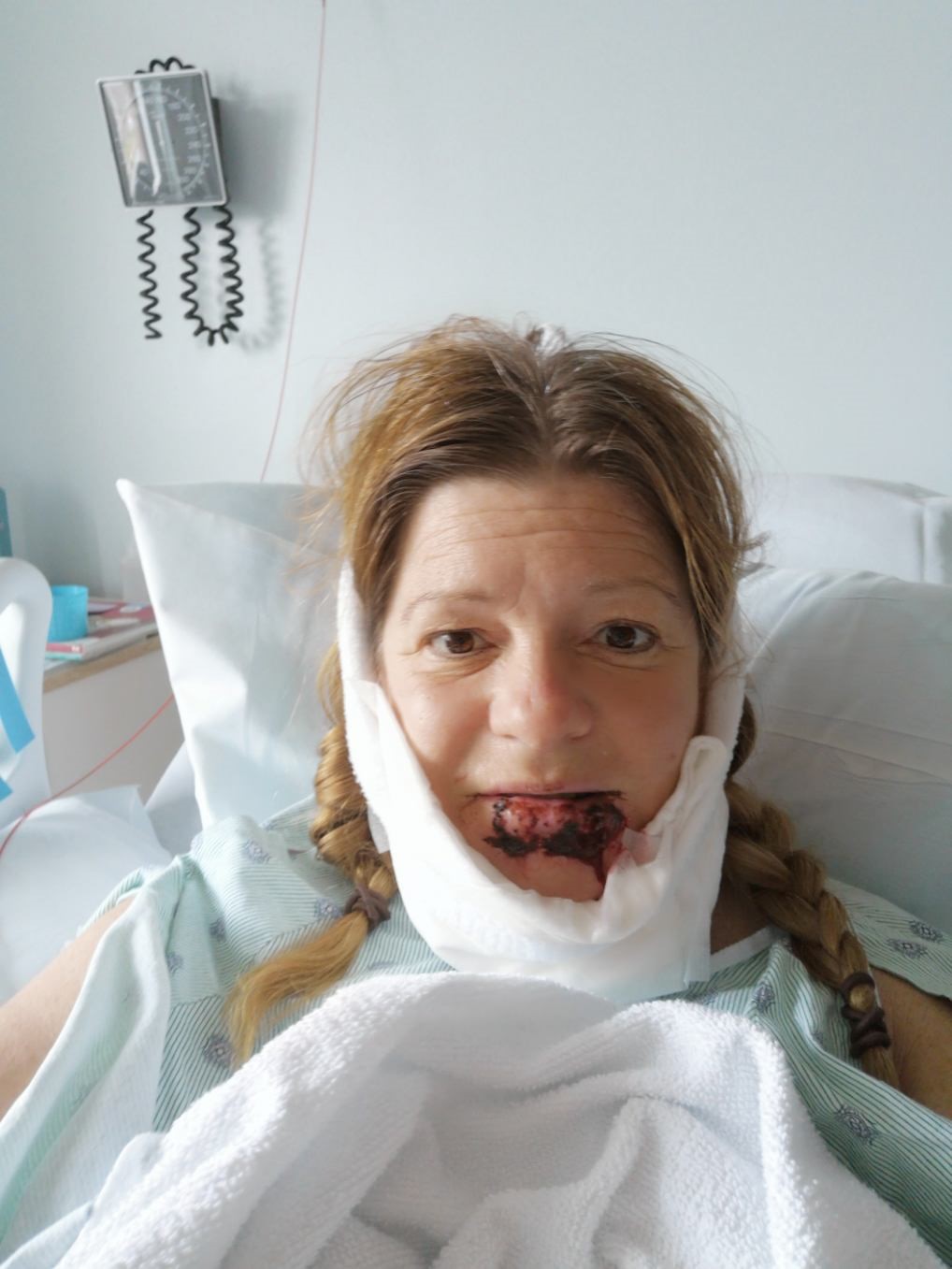 Carolyn Deschenes has a long road to recovery after a dog bit off her lip.