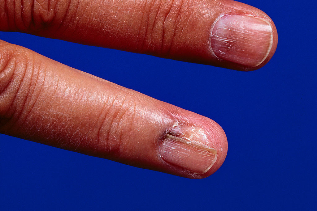 When melanoma hides: Woman develops skin cancer under her nail - image