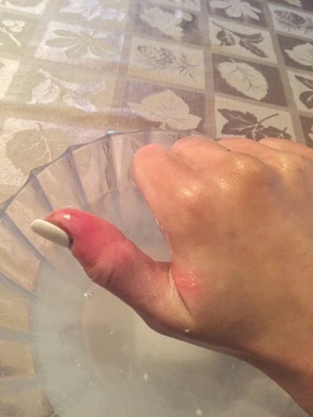 When melanoma hides: Woman develops skin cancer under her nail - image