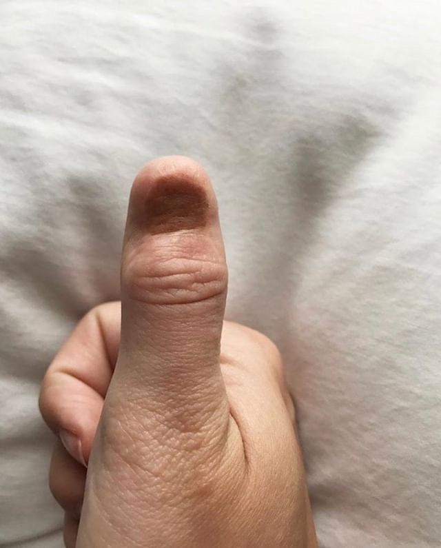 When melanoma hides: Woman develops skin cancer under her nail - image