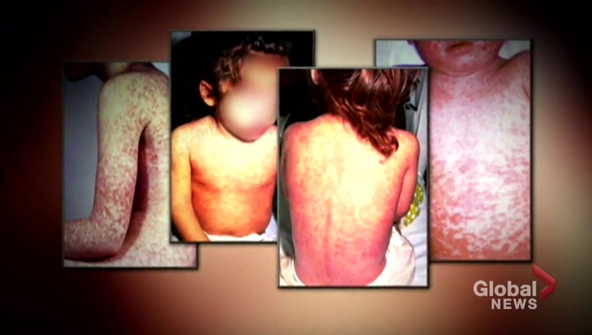 N.B. Chief Medical Officer warns of potential measles exposure in Greater Moncton area - image