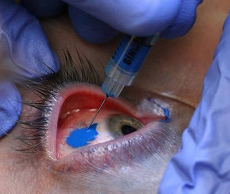 Scleral tattooing.