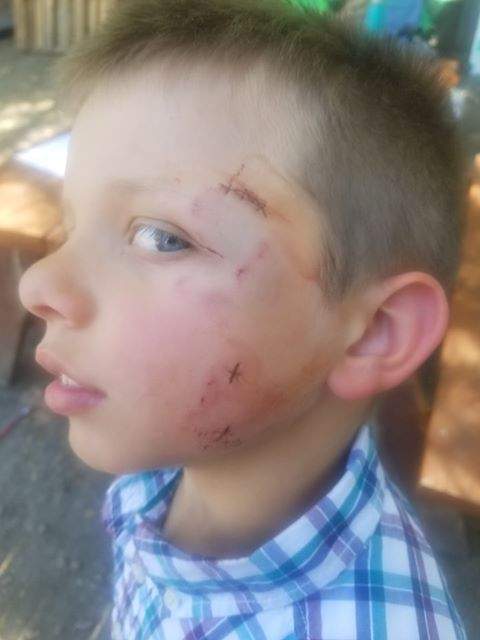Riley Dubbin-Shaw, an 8-year-old Kelowna boy, needed numerous stitches on his face after a dog attack on Tuesday morning.