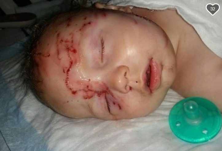 A seven-month-old child is being treated for extensive injuries following a dog attack in Penticton on May 31, according to Daniel Hill, the child’s uncle.