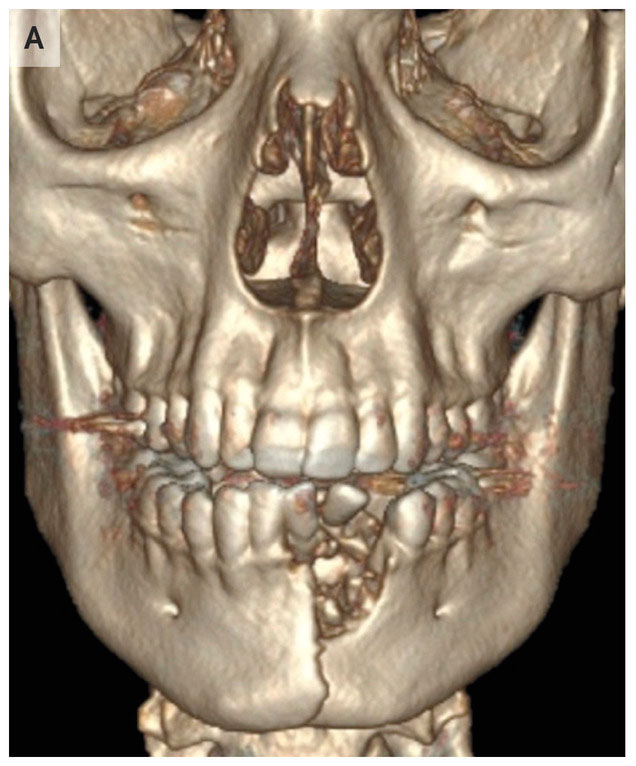 A reconstructed image of the patient’s head, showing the fracture in his jaw.